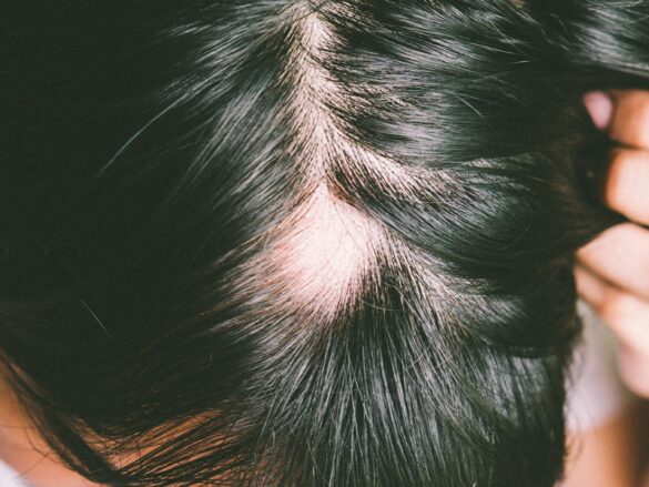 Sores on Scalp Causes, with Hair Loss and Treatments