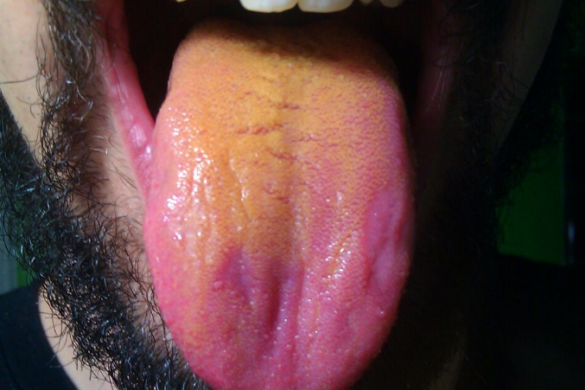 Inflamed Enlarged Or Swollen Taste Buds On Back Tip Side Of Tongue.