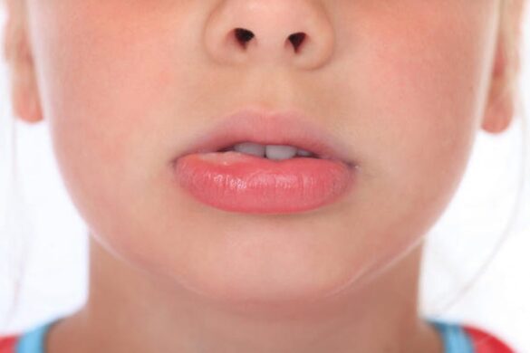 How To Get Rid Of Upper Lip Lines Permanently